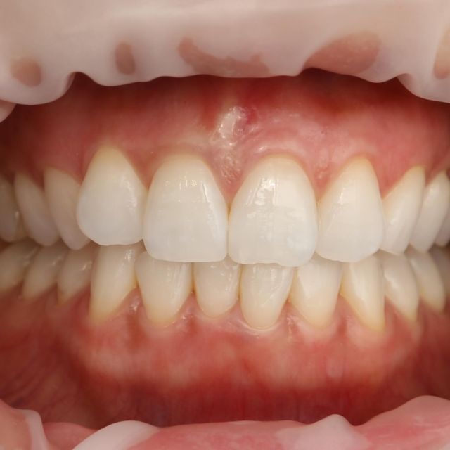 こんにちは、椎名町駅えがお歯科です。
．
ガムピーリングの症例写真です🤳✨
1枚目施術後、2枚目施術前、3枚目施術中となります。
術後約14日で1枚目の状態になりました☺️
ホワイトニングをせずとも、
歯がより輝いて見えますね🦷
．
ガムピーリングとは、メラニン色素の黒ずんだ歯肉をピンク色に回復させるという施術方法です。
喫煙により歯茎が黒くなった方、
受動喫煙によって歯茎が茶色に濁った方へ
人気の施術です✨
．
ガムとは歯茎のことです。
着色の主な原因は、メラニン色素です。
メラニン色素は紫外線や喫煙、食物の刺激などが原因で皮膚の表皮最下層の基底層にメラノサイト（色素細胞）で生成されます。お肌と同様、表層だけに存在しているので、メラニン除去・ピーリングにてキレイにする事ができます💡
．
注意事項
※ガムピーリング後、刺激の強い食べ物（辛い物や塩辛い物など）は、控えて下さい。
※痛みに対する反応は個人差があります。
※やけどをしたようなヒリヒリ感を感じる場合もあります
※ガムピーリング後、2～7日間くらい歯ぐきが白っぽくなります。
（1週間後辺りから白濁は消失し、健康歯ぐきの色調になってきます）
※個人差にもよりますが、生活状況によっては、再発する事があります。
．
興味のある方はぜひ、スタッフにお声がけください😊
．
#椎名町駅えがお歯科
#椎名町駅 #西武池袋線 
#池袋 #豊島区 #目白 #落合南長崎 #山手通り 
．
#歯科 #歯科開業 #歯科医院 #デンタルクリニック 
#歯科医師 #歯科衛生士 #歯科助手
．
#歯の健康 #予防歯科 #虫歯予防 #定期検診 #8020運動
#歯周病治療 #審美歯科 #小児歯科 
#虫歯治療 #歯周病 #知覚過敏 
#噛み合わせ #ホワイトニング 
#デンタルエステ #ガムピーリング